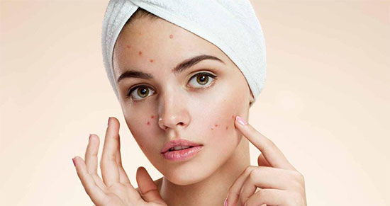 جوش و آکنه؛ چه کنیم که جوش نزنیم؟ چگونه از شر انواع جوش و آکنه خلاص شویم؟