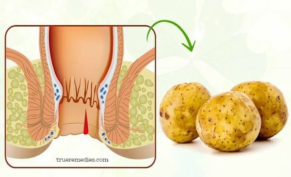 درمان زگیل مقعد با سیب زمینی