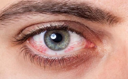 چه موقع قرمزی چشم را باید جدی بگیریم؟ چه موقع قرمزی چشم را باید جدی بگیریم؟