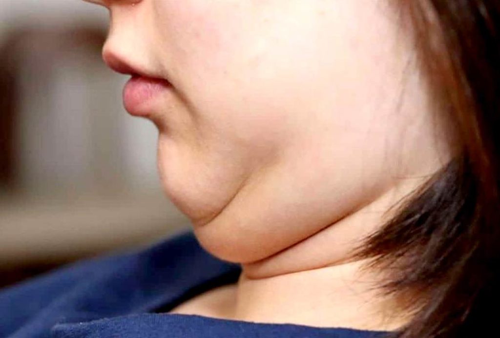 چگونه غبغب را از بین ببریم؟ چگونه غبغب را از بین ببریم؟