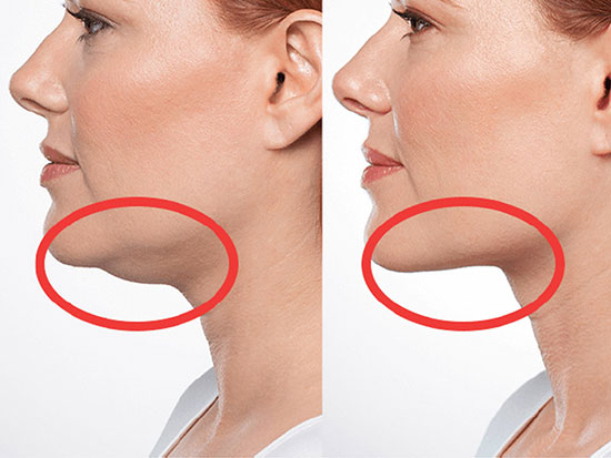 چگونه غبغب را از بین ببریم؟ چگونه غبغب را از بین ببریم؟