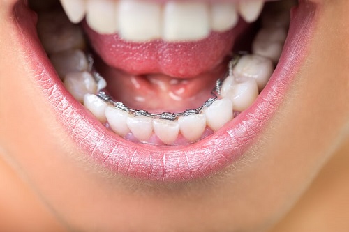 انواع ارتودنسی کودکان، قیمت و عکس انواع ارتودنسی کودکان، قیمت و عکس