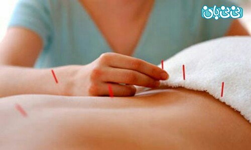طب سوزنی برای کمر درد و هرآنچه باید درباره آن بدانید طب سوزنی برای کمر درد و هرآنچه باید درباره آن بدانید