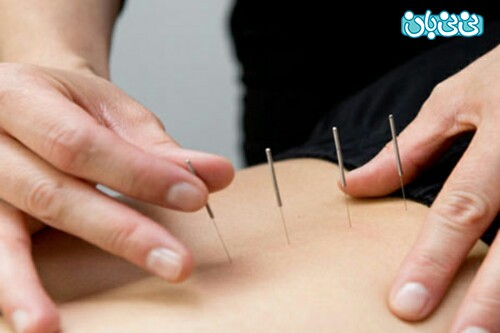 طب سوزنی برای کمر درد و هرآنچه باید درباره آن بدانید طب سوزنی برای کمر درد و هرآنچه باید درباره آن بدانید