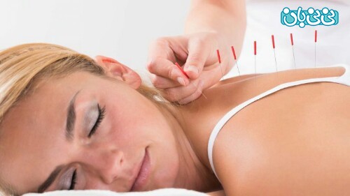 طب سوزنی برای کمر درد و هرآنچه باید درباره آن بدانید طب سوزنی برای کمر درد و هرآنچه باید درباره آن بدانید