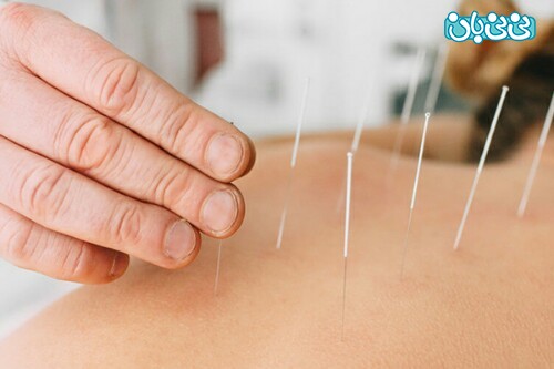 طب سوزنی برای کمر درد و هرآنچه باید درباره آن بدانید طب سوزنی برای کمر درد و هرآنچه باید درباره آن بدانید