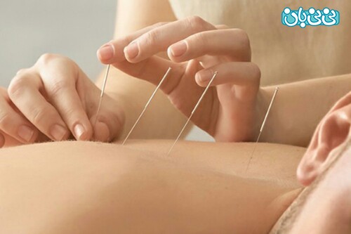 طب سوزنی برای کمر درد و هرآنچه باید درباره آن بدانید طب سوزنی برای کمر درد و هرآنچه باید درباره آن بدانید