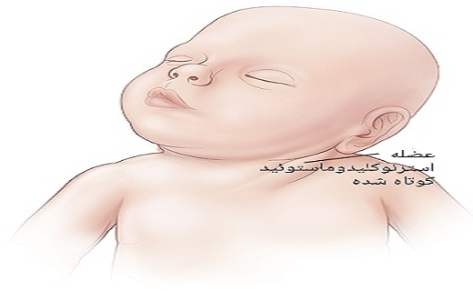 عضله استرنوکلیدوماستوئید کوتاه شده عضله استرنوکلیدوماستوئید کوتاه شده