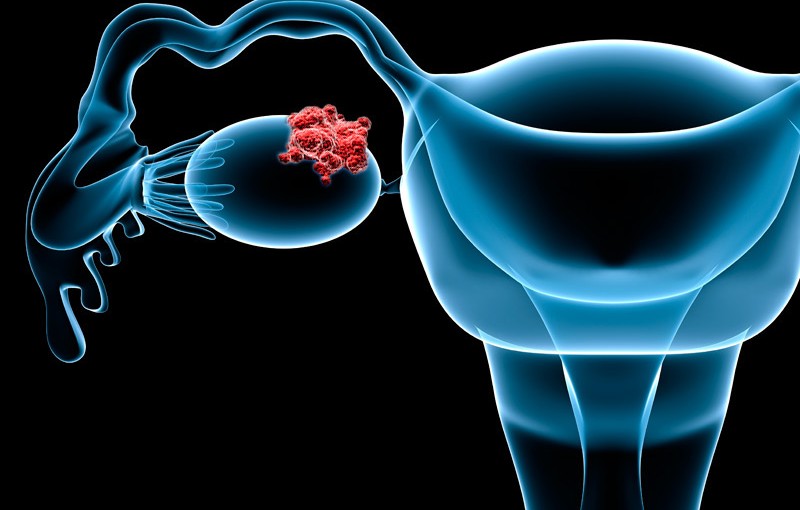 علائم سرطان تخمدان؛ می‌دانستید جواب تست پاپ‌اسمیر تعیین کننده نیست؟