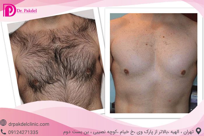آیا لیزر موهای زائد تاثیری دارد؟ آیا لیزر موهای زائد تاثیری دارد؟