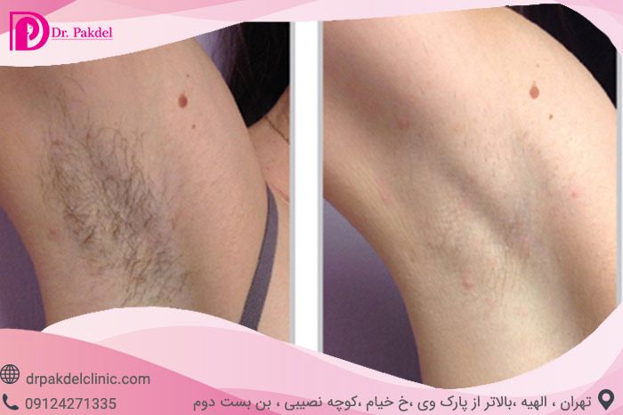 آیا لیزر موهای زائد تاثیری دارد؟ آیا لیزر موهای زائد تاثیری دارد؟