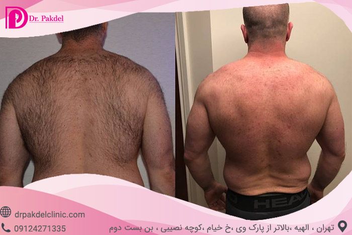 آیا لیزر موهای زائد تاثیری دارد؟ آیا لیزر موهای زائد تاثیری دارد؟