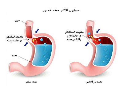 چگونه از رفلاکس معده خلاص شویم؟