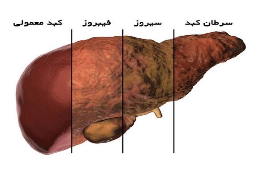 ابداع روشی جدید برای تشخیص التهاب کبد