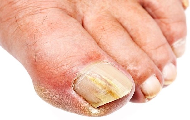 ناخن شست پا چرا زرد میشود؟ ناخن شست پا چرا زرد میشود؟