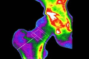 آزمایش غربالگری برای تشخیص پوکی استخوان در زنان