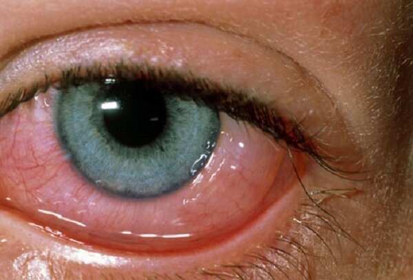روزاسه چشمی چیست و چه علائمی دارد؟
