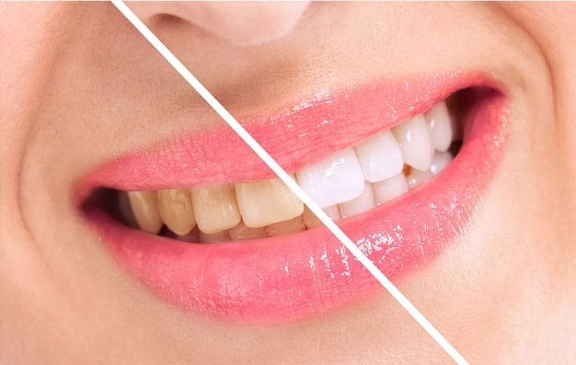 پلاک‌ها چه تاثیری در تشکیل جرم دندان دارند؟