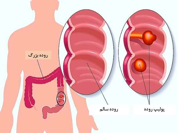 نکاتی درباره پولیپ روده بزرگ