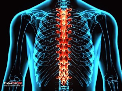 تحریک طناب نخاعی در کاهش نوروپاتی دیابتی موثر است