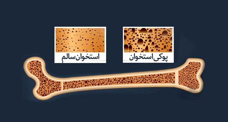 چرا جهان بر علیه پوکی استخوان هم داستان شده است؟‌