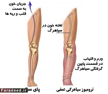 درمان جادویی واریس و لختگی خون