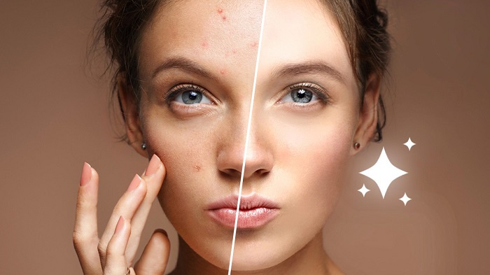 از بین بردن جای جوش با ساده ترین روش ها از بین بردن جای جوش با ساده ترین روش ها