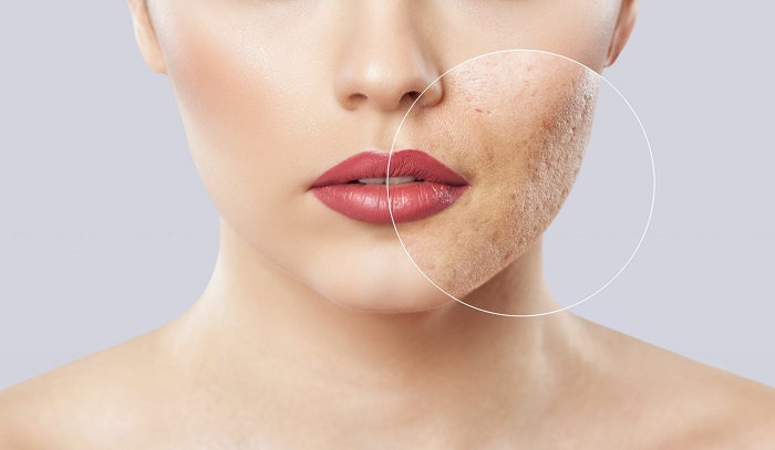 از بین بردن جای جوش با ساده ترین روش ها از بین بردن جای جوش با ساده ترین روش ها